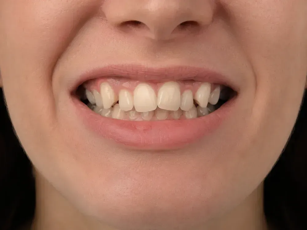 Before smile correction with visible crowding in the front teeth